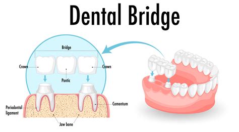 Best Dental Bridge Treatment Singapore Offers Improved Smiles