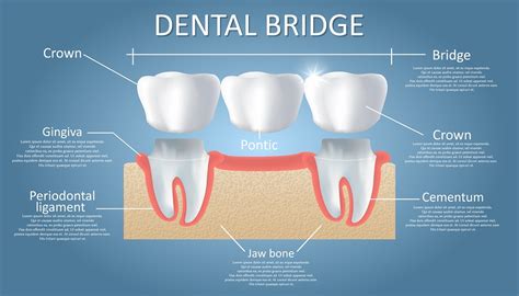Dental Bridge Treatment UK: Expert Solutions Unveiled