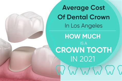 Unlocking Affordable Dental Crown Cost in LA
