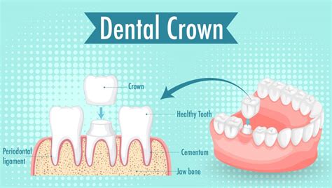 Dental Crown Cost Near Me: Your Local Guide