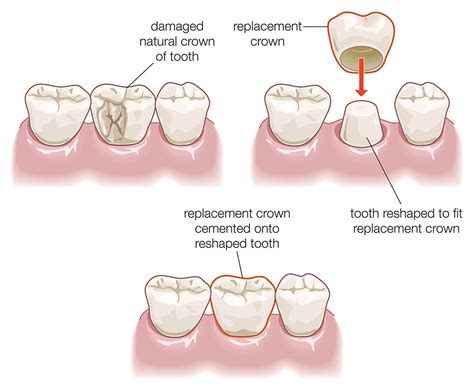 Everything You Need to Know About Dental Crown Cost Procedure