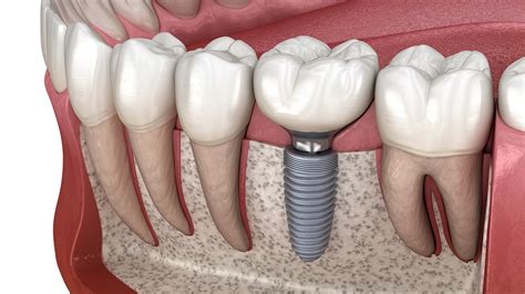 Unlock Superior Smiles with Dental Implants Advanced Treatment