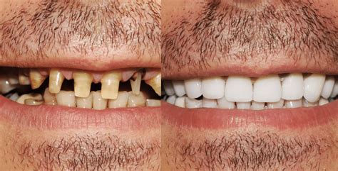 Dental Implants Before and After: Transformative Smile Makeovers Revealed