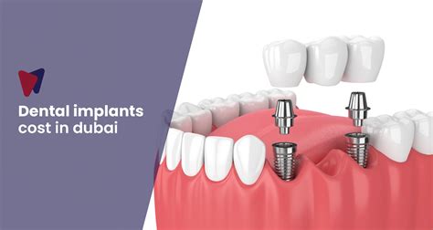 Dental Implants Cost in Dubai Uncovered 2023