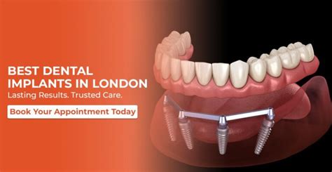 Best Dental Implants London Solution Revealed