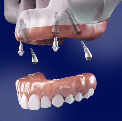 Best Dental Implants Near Me Reviews