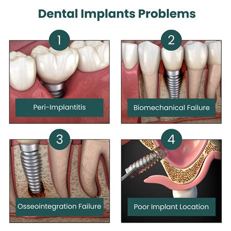 Dental Implants Risks: What You Must Know