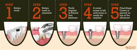 Mastering Dental Treatment Step by Step Guide for Optimal Oral Health