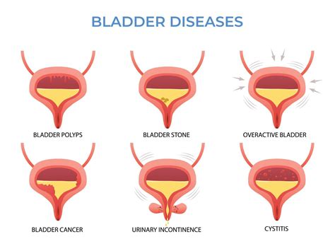 Understanding Disorders Of Urinary Bladder Symptoms To Watch For