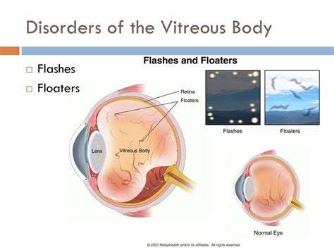 Understanding Disorders Of Vitreous Body: Causes And Treatments