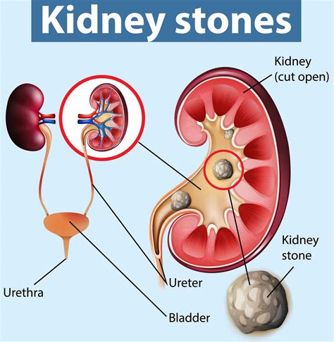 Does Gravity Affect Kidney Stones? The Surprising Truth