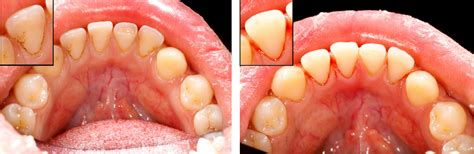 Early Warning Signals of Gum Disease You Shouldnt Ignore