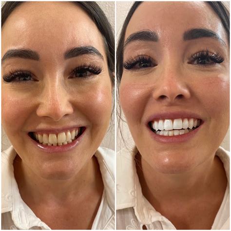 Emergency Dentist: Before and After Transformations
