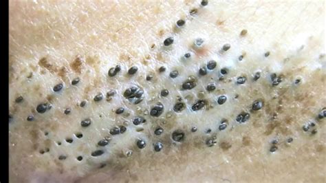 Deadliest Blackheads That Wont Come Out