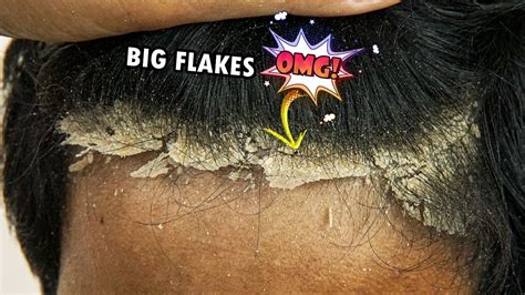 Seeing Through Your Scalp: Understanding Extreme Cases Of Dandruff
