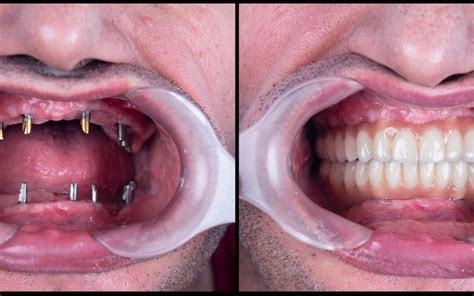 Full Mouth Dental Implants: Advanced Treatment Revolutionizes Smiles