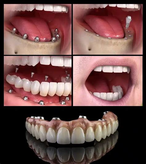 Full Mouth Dental Implants Australia Breakthrough: Transform Your Smile Today