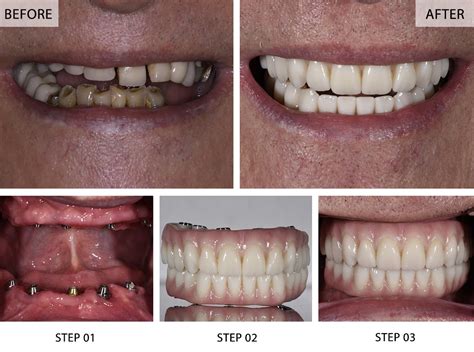 Full Mouth Dental Implants London Guide for Transformative Smiles