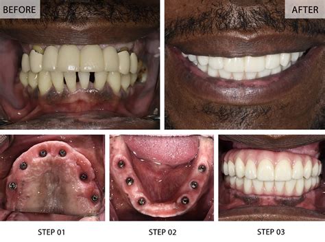 Full Mouth Dental Implants Recovery Time Secrets