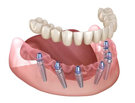 Top Dentist for Full Mouth Dental Implants: Your Guide to Perfect Smiles