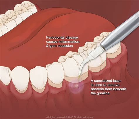 Gum Disease Prevention: Expert Dentist Advice