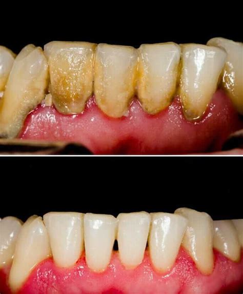 Gum Disease Treatment Before and After Results