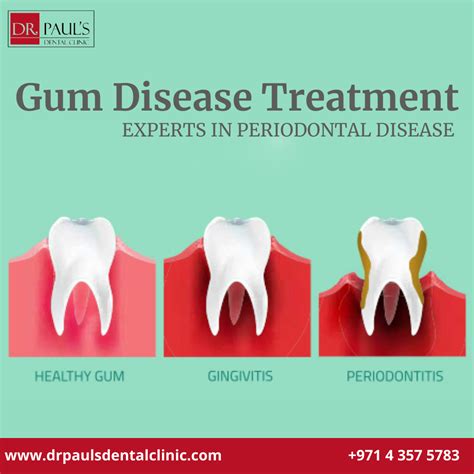Understanding Gum Disease Treatment Cost in Dubai: What to Expect