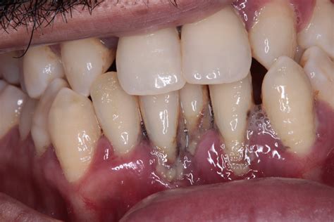 Best Gum Disease Treatment London Offers: Find Relief Today