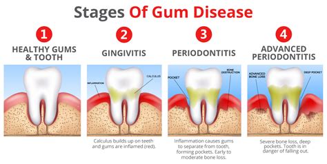Gum Disease Treatment: Long Lasting Results!
