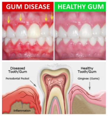 Best Gum Disease Treatment Near Me