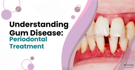 Affordable Gum Disease Treatment Payment Plan Available Now