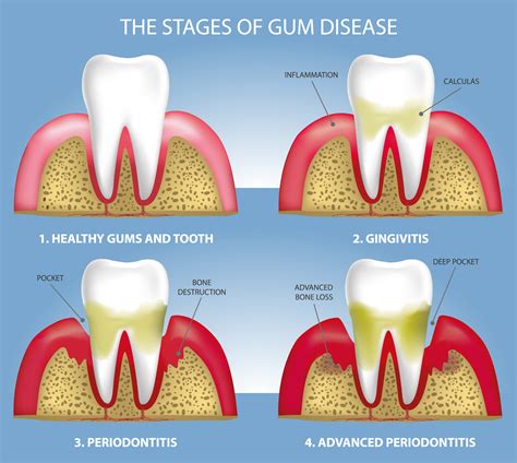 Uncovering Gum Disease Treatment Risks: What You Need to Know