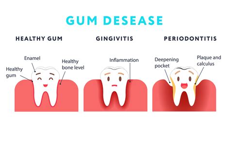 Gum Health Explained: Your Complete Guide