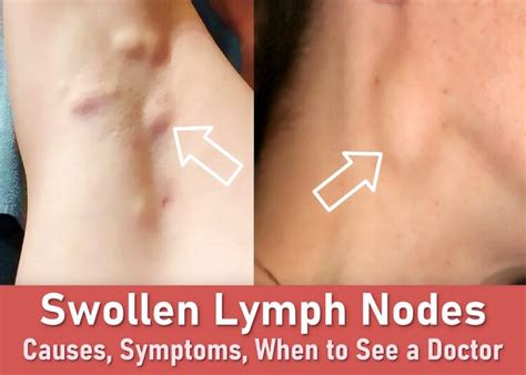 How Big Can Lymph Nodes Swell And Is It Dangerous?