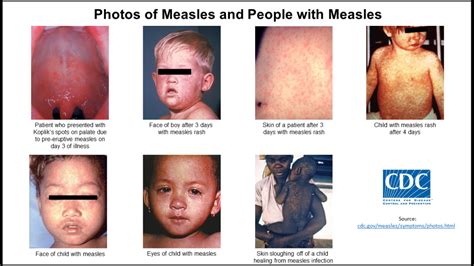 How Children Die Of Measles: A Medical Breakdown
