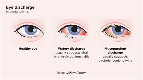 How Eyes Fight Infection: Biological Defenses Explained