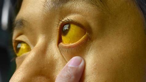 How Do Jaundice Eyes Look Like A Complete Guide To Symptoms