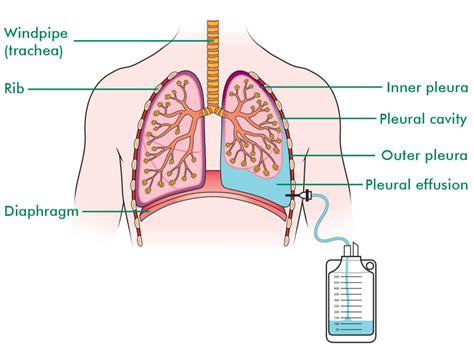 How Lungs Drain Fluid: The Natural Process Explained