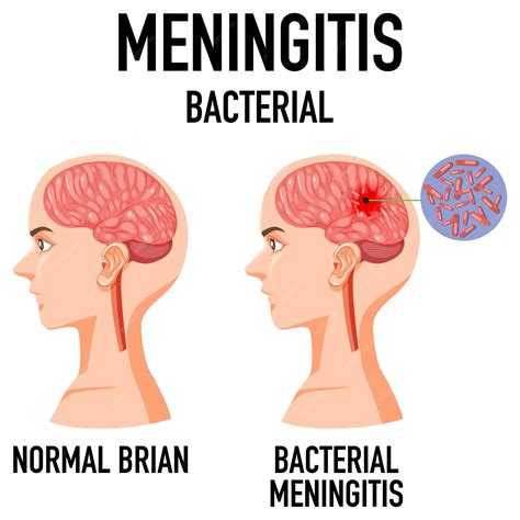 What Are The Early Symptoms Of Bacterial Meningitis