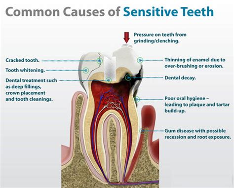 Top Tricks to Improve Tooth Sensitivity Now