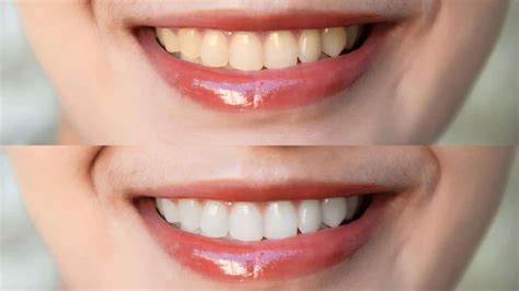 Improve Whitening Teeth Naturally Proven Tips