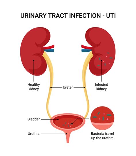How To Overcome Urinary Tract Infection Naturally And Fast
