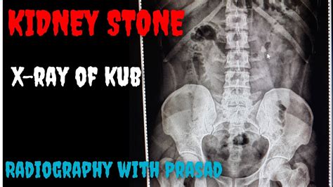 How To Prepare For An X Ray Kidney Ureter Bladder Without Stress