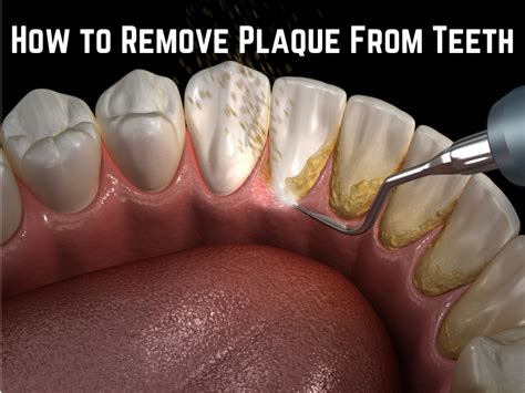 Expert Tips: Prevent Plaque Removal Easily!
