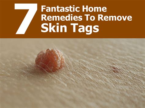 The Best Ways To Safely Remove Skin Tags At Home: What Pros Recommend