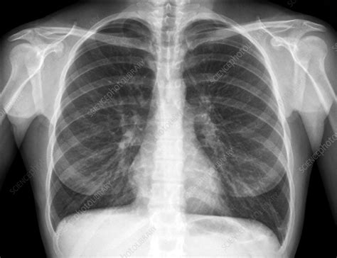 How To See Lungs On X Ray: A Stepbystep Guide