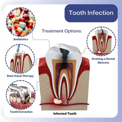 Best Practices: Treat Tooth Protection Now