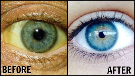 How To Whiten Eyes Quickly: 5 Safe Home Remedies To Try Today