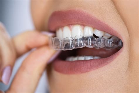 Quick Invisalign 24-Hour Service Solution