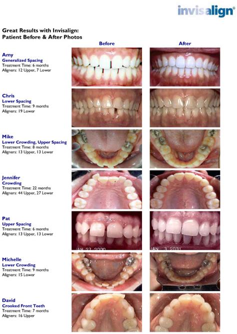 Invisalign Treatment: Ultimate Long-Lasting Results